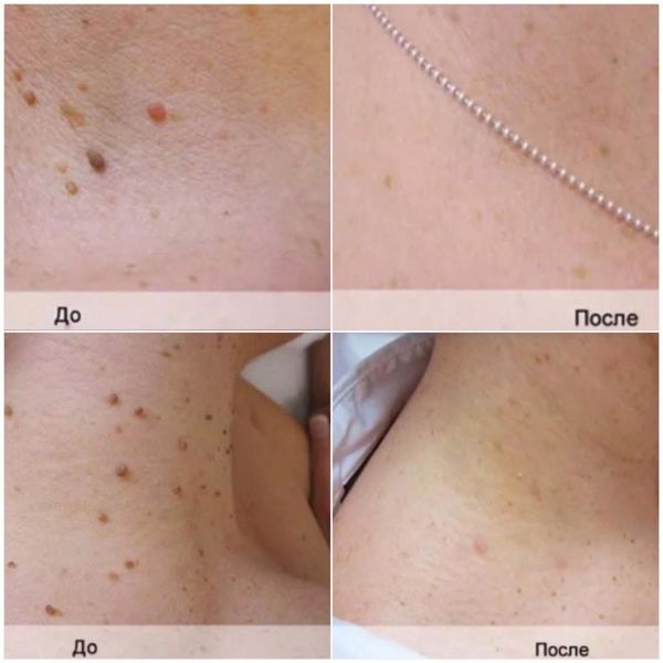 16028 Аппарат электрокоагуляции -112 (GT-112) DIY  - Вид №3