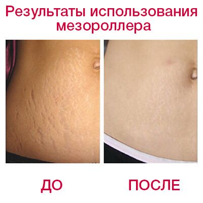 52585 Мезороллер Hydra Roller с ёмкостью для мезококтейля с титановыми позолоченными микроиглами, 64 иглы Beauty Star  - Вид №1