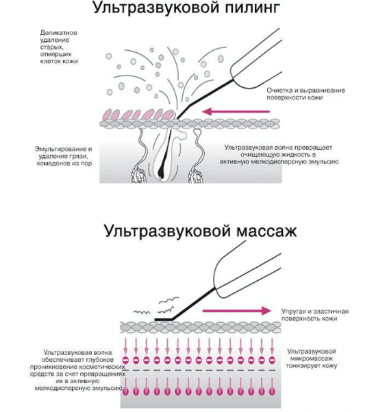 24411 Аппарат УЗ пилинга и УЗ терапии (фонофорез) Nova NewFace NV-233A (GT-233A) Nova NewFace (НОВА НьюФейс)  - Вид №3